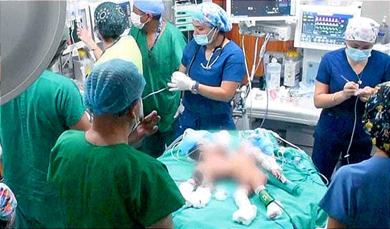 ¡HAZAÑA MÉDICA! UN PAR DE GEMELOS SIAMESES, UNIDOS POR EL VIENTRE, FUERON EXITOSAMENTE SEPARADOS EN EL HOSPITAL SAN BARTOLOMÉ DE LIMA, PERÚ.