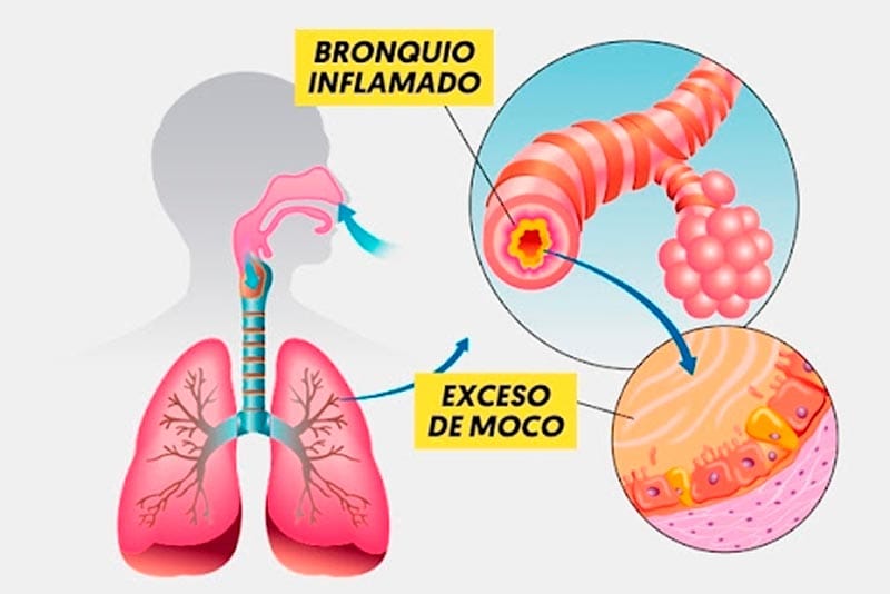 TIPS PARA MEJORAR LA CALIDAD DE VIDA | BRONQUITIS - Para sobrevivir, el cuerpo necesita suministro constante de oxigeno, el cual obtiene del aire exterior, y los canales que lo conducen hacia los pulmones son los bronquios...