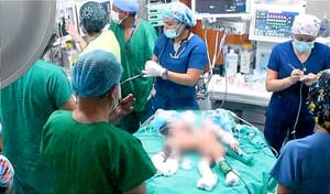 ¡HAZAÑA MÉDICA! UN PAR DE GEMELOS SIAMESES, UNIDOS POR EL VIENTRE, FUERON EXITOSAMENTE SEPARADOS EN EL HOSPITAL SAN BARTOLOMÉ DE LIMA, PERÚ.