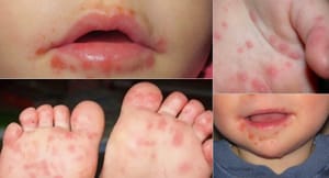 ¡CUIDADO CON EL COCSACKIE, ES ALTAMENTE CONTAGIOSA!