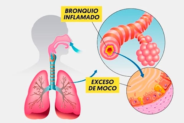 TIPS PARA MEJORAR LA CALIDAD DE VIDA | BRONQUITIS - Para sobrevivir, el cuerpo necesita suministro constante de oxigeno, el cual obtiene del aire exterior, y los canales que lo conducen hacia los pulmones son los bronquios...