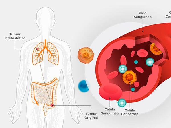 TIPS PARA MEJORAR LA CALIDAD DE VIDA | EL CANCER - El cáncer es una célula que ha perdido sus mecanismos de control normales, y que adquiere por ello un crecimiento descontrolado. Puede desarrollarse a partir de cualquier tejido...