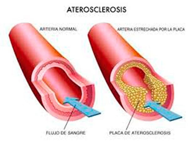 TIPS PARA MEJORAR LA CALIDAD DE VIDA | ATEROESCLEROSIS... MÁS COMÚN DE LO QUE IMAGINA - Es trastorno en el que se presenta endurecimiento y estrechamiento de las paredes de las arterias a causa de cúmulos de colesterol, disminuyendo...